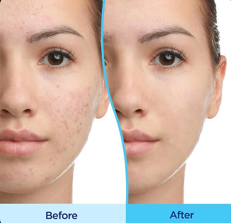 خرید ژل ضد جوش دیفرین مدل Adapalene حجم 30 میلی لیتر