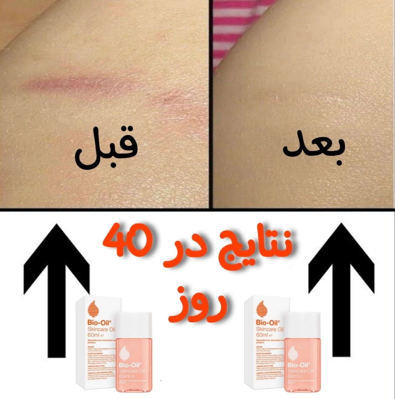 روغن ضدترک بدن بایو اویل Bio Oil حجم ۱۲۵ میل